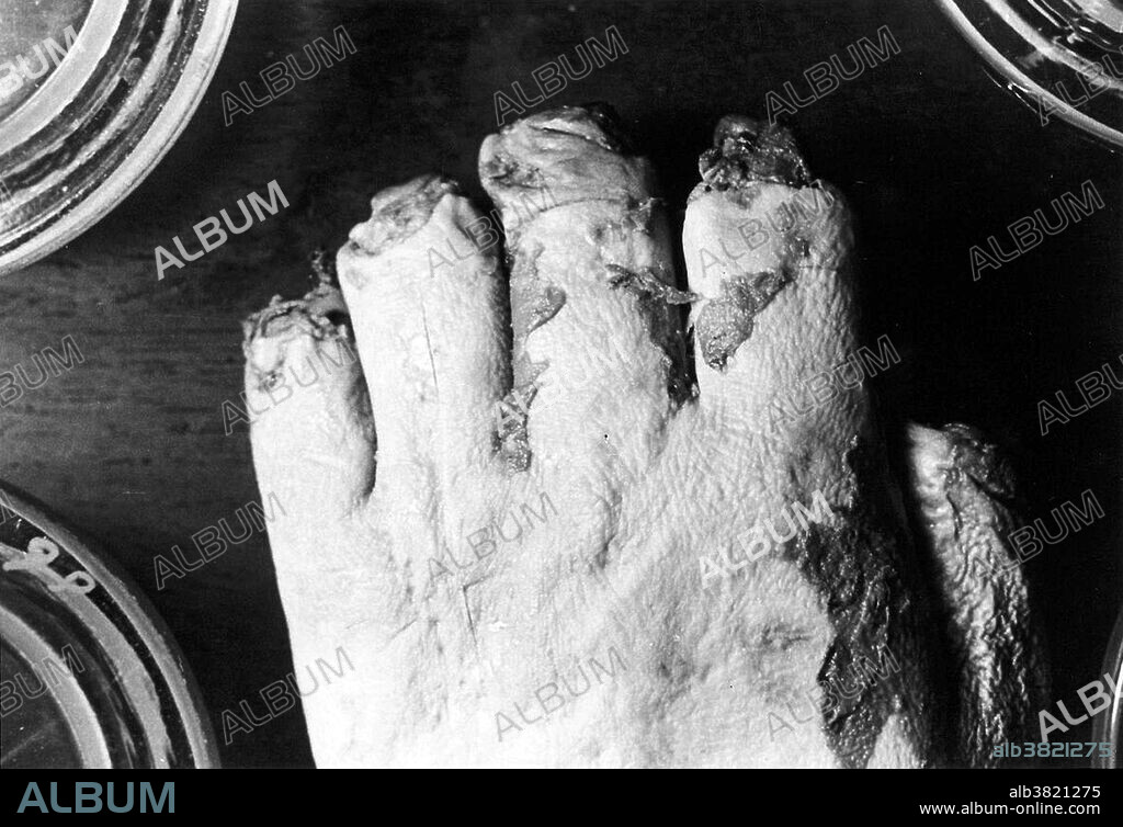 The tips of the fingers of the victims were cut off to prevent fingerprint identification, 1935. The skill with which the fingers were mutilated led police to hypothesize that the murderer had anatomical training and knew how to use a scalpel. Buck Ruxton (1899-1936) was a Parsi doctor and murderer who strangled his wife Isabella. In order to prevent their housemaid, Mary Jane Rogerson, from discovering his crime before he could dispose of the body, he suffocated her too. Ruxton then proceeded to dismember and mutilate both bodies to hide their identities. The case is remembered now for the innovative forensic techniques employed in solving it. The bodies were identified using the fledgeling techniques of fingerprint identification, forensic anthropology to superimpose a photograph over the X-ray of a victim's skull and forensic entomology to identify the age of maggots and thus the approximate date of death. This was one of the first cases where such forensic evidence was successfully used to convict a criminal in the United Kingdom.