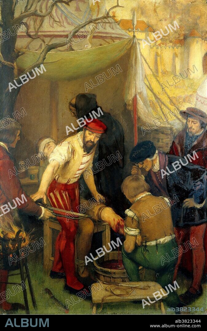 Ambroise ParÃ© using a ligature while amputating a man's leg on the battlefield at the siege of Bramvilliers, 1552. Oil painting by Ernest Board. ParÃ© (1510-1590) was a French surgeon, anatomist and inventor. He was royal surgeon for kings Henry II, Francis II, Charles IX and Henry III and is considered one of the fathers of surgery and modern forensic pathology. He was a leader in surgical techniques and pioneered modern battlefield wound treatment. Battlefield medicine is the treatment of wounded soldiers in or near an area of combat. Civilian medicine has been greatly advanced by procedures that were first developed to treat the wounds inflicted during combat. ParÃ© introduced the ligature of arteries instead of cauterization during amputation. He believed that phantom pains occurred in the brain. He contributed to the practice of surgical amputation and the design of limb prostheses.
