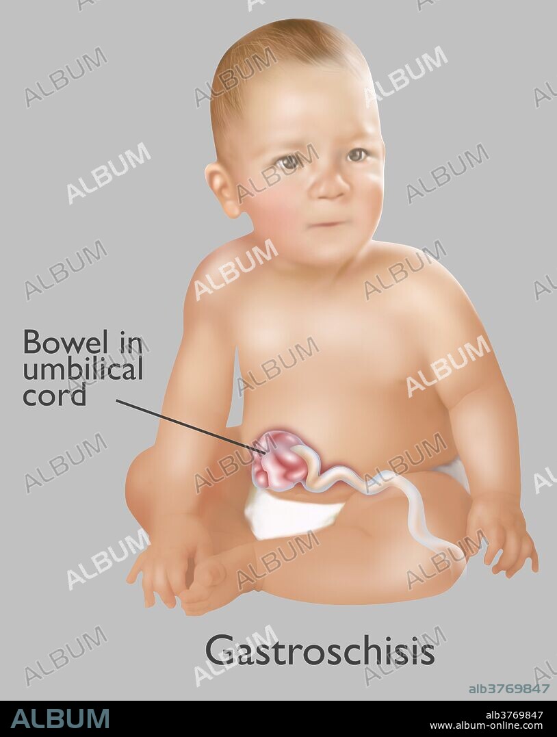 An illustration of a baby with Gastroschisis. Gastroschisis is a congenital defect in the anterior abdominal wall which allows for the contents of the digestive system to protrude. 1 baby in 30 is born with one or more major birth defects. Most are correctable with modern surgery.