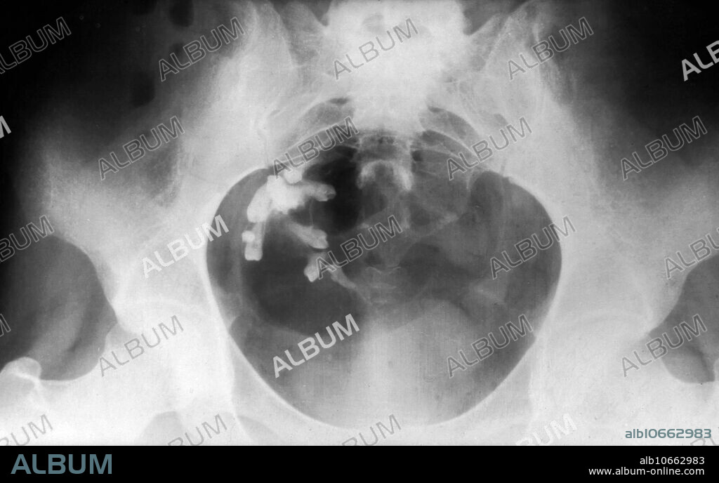 Dermoid cyst. A dermoid cyst is a teratoma of a cystic nature that contains an array of developmentally mature, solid tissues. It frequently consists of skin, hair follicles, and sweat glands, while other commonly found components include clumps of long hair, pockets of sebum, blood, fat, bone, nails, teeth, eyes, cartilage, and thyroid tissue. As dermoid cysts grow slowly and contain mature tissue, this type of cystic teratoma is nearly always benign.