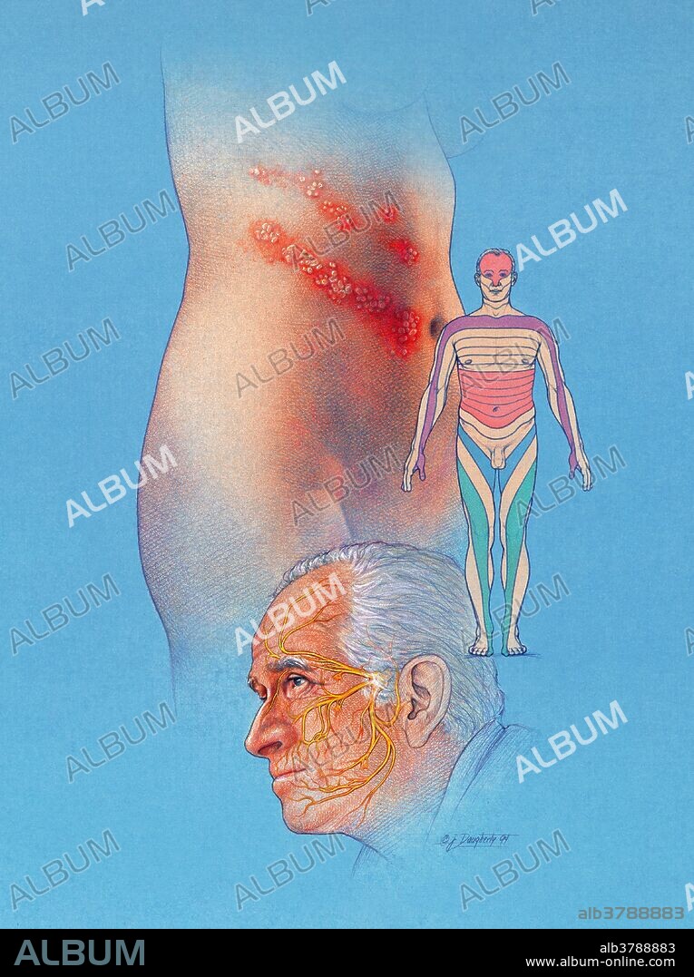 Shown are the typical Herpes Zoaster "shingles", lesions on the torso, a map of some dermatomes that may be affected, and the course of the trigeminal nerve.