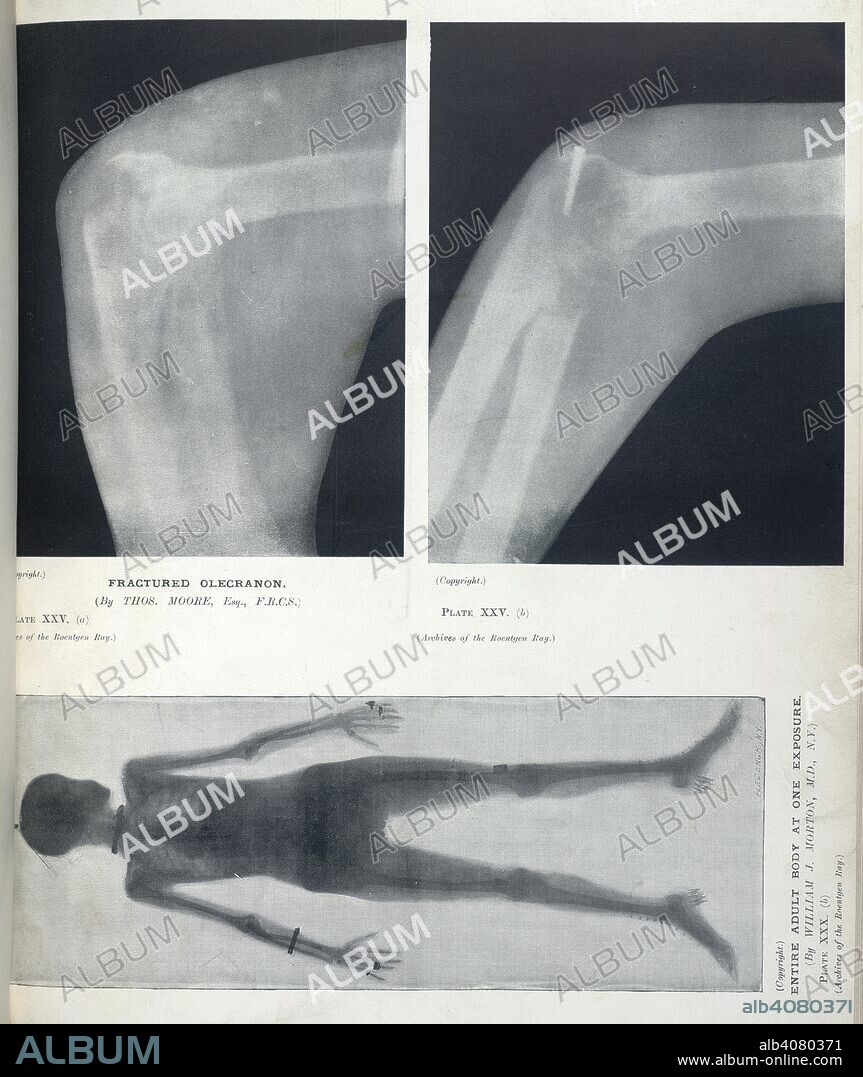 Plate XXV. (a): Fractured olecranon. (By Thos. Moore, esq. F.R.C.S.) Plate XXV. (b): As above. Plate XXX. (b): Entire adult body at one exposure. (By William J. Morton. M.D, N.Y.). Archives of the Roentgen ray. London : Heinemann, 1897-1915. Source: 1640.750000 vol.ii, page 98.