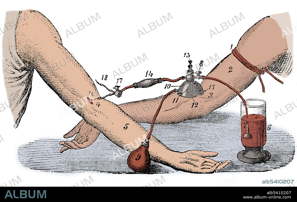 Blood transfusion between two people, J. Roussel, 1876. Beginning with Harvey's experiments with circulation of the blood, research into blood transfusion began in the 17th century, with successful experiments in transfusion between animals. However, successive attempts by physicians to transfuse animal blood into humans gave variable, often fatal, results. Early transfusions between humans were risky and many resulted in the death of the patient. It was not until 1901, when the Austrian Karl Landsteiner discovered human blood groups, that blood transfusions became safer.