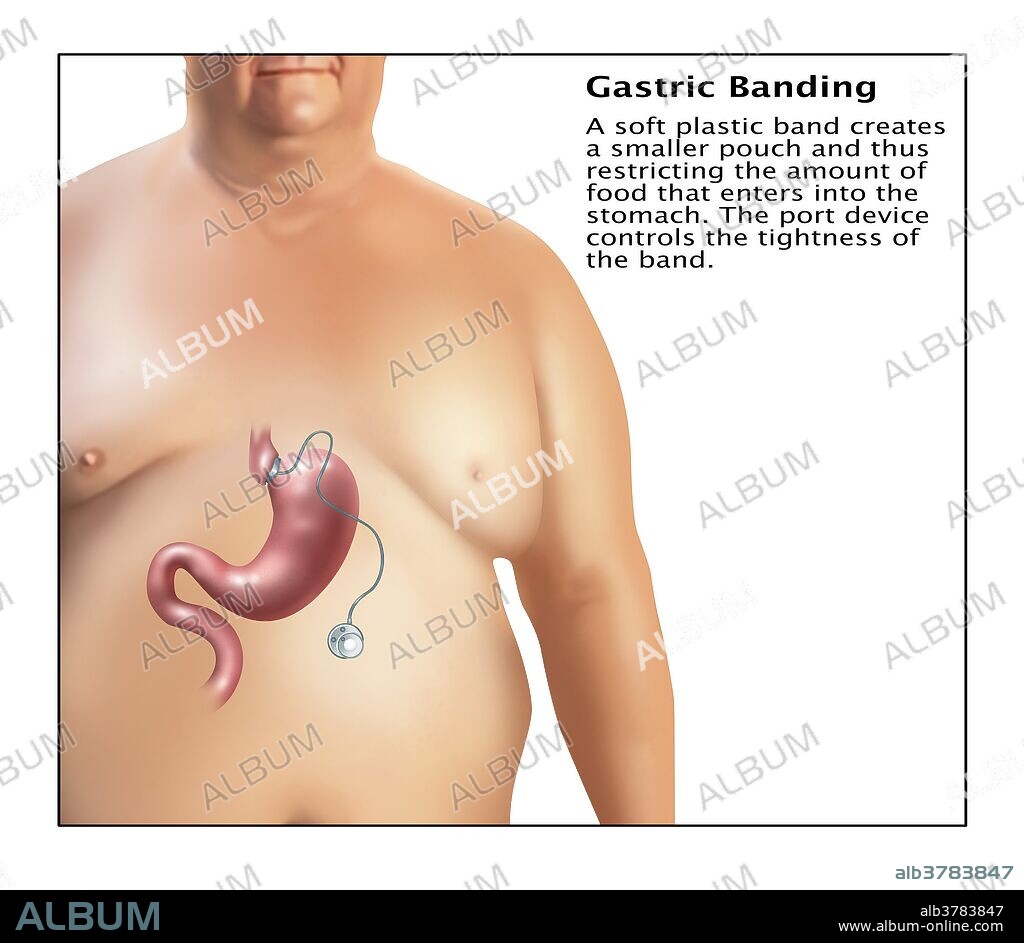 Illustration of gastric banding. A laparoscopic adjustable gastric band, commonly called a lap-band, A band, or LAGB, is an inflatable silicone device placed around the top portion of the stomach to treat obesity, intended to slow consumption of food and thus reduce the amount of food consumed. A soft plastic band creates a smaller pouch, thus restricting the amount of food that enters into the stomach. The port device controls the tightness of the band.