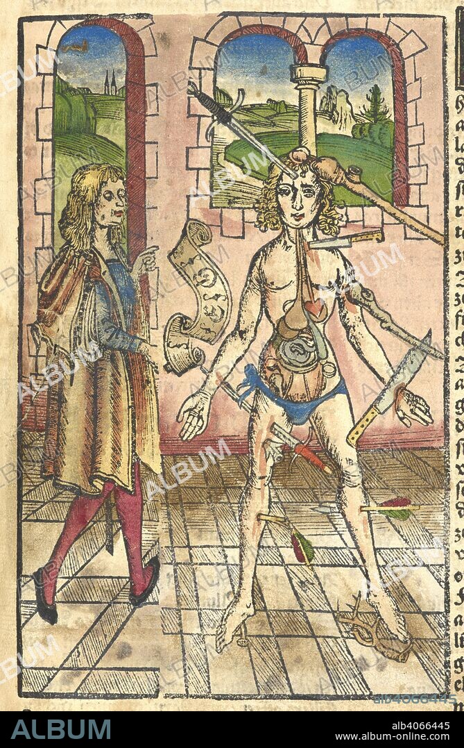 HIERONYMUS BRAUNSCHWEIG. Coloured woodcut showing 'a wound man.' It shows the various wounds a person might suffer in battle or in accidents. Das buch zu distillieren die zusamen gethonen ding Composita genant, durch die eintzigeÌ„ ding, und das buch Thesaurus pauperuÌ„, fuÌˆr die armen ... geoffenbart, etc. [With woodcuts.]. Durch I. GruÌˆninger: Strassburg, 1519. Source: C.64.g.7 page CCLIIIIr.