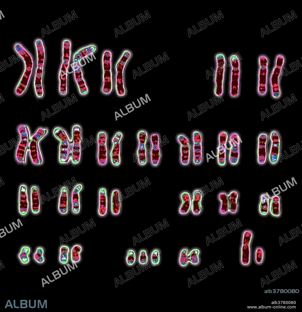 Down syndrome human karyotype 47, XY, +21. This male has a full chromosome complement plus an extra chromosome 21. Symptoms include a varying degree of mental retardation, growth failure, muscular hypotoicity, flay occiput, large tongue, slanting eyes, simian palmar crease, intestinal and heart problems, and acute leukemia. Older survivors often develop Alzheimer's disease in their fourth or fifth decade. The syndrome is associated with advanced maternal age. Supplied by Wessex Reg. Genetics Centre, courtesy of Wellcome Images.