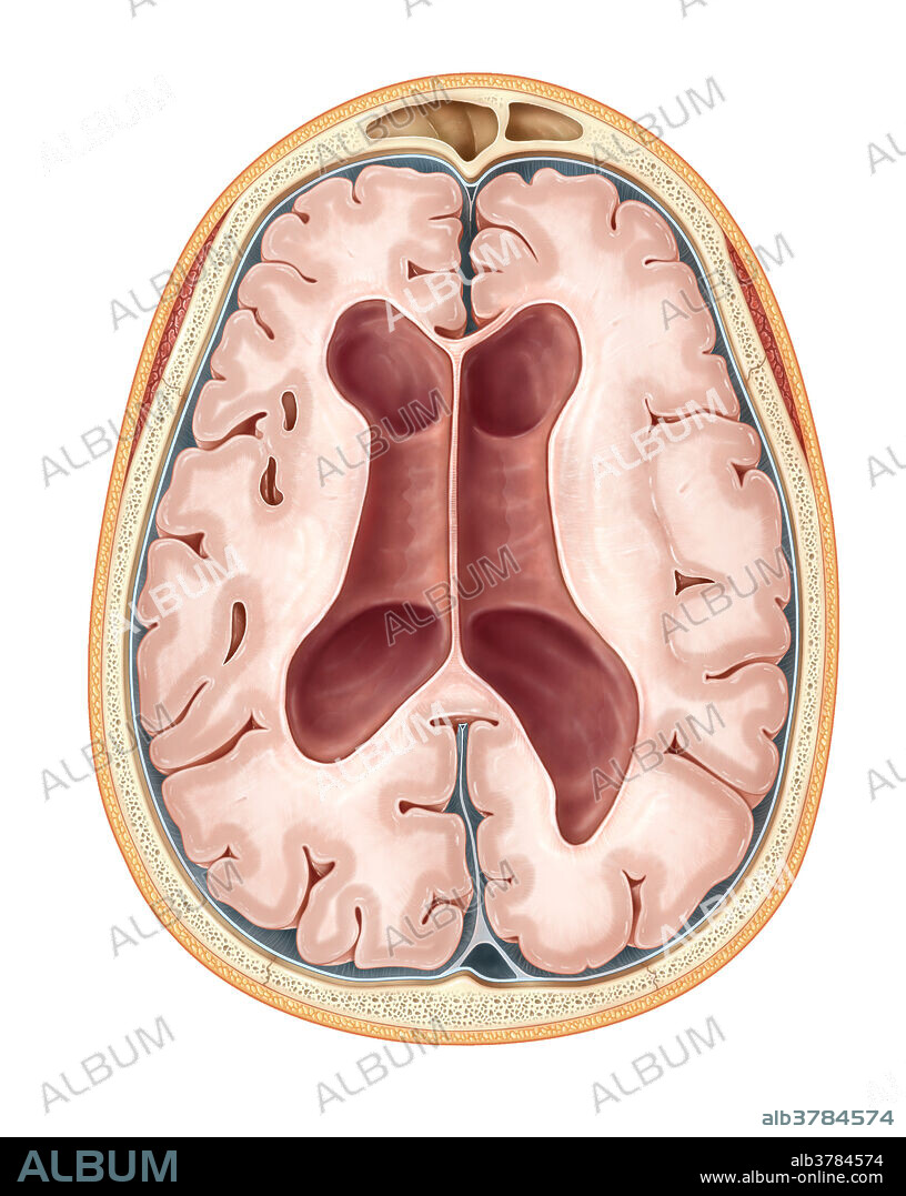 This axial (cross sectional) illustration of the brain shows disproportionate enlargement of the ventricular system which is out of proportion to the degree of atrophy. This condition is called communicating hydrocephalus or normal pressure hydrocephalus (NPH). This is usually seen in the elderly and can cause a clinical triad of dementia, urinary incontinence and gait apraxia. This triad of symptoms is called the Hakim-Adams triad. This condition can be idiopathic or secondary to previous intracranial bleeding, trauma, infection or tumour which can impair the CSF resorption through the arachnoid granulations.
