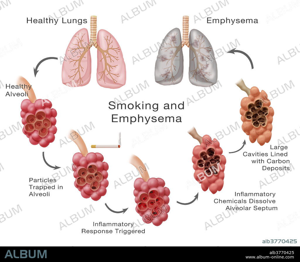 Stages of lung damage of a smoker leading to emphysema. The illustration cycles from the top left healthy lung down and around to the top right lung suffering from emphysema. Healthy lungs showing a healthy alveoli. Particles become trapped in the alveoli which triggers inflammation. Inflammatory chemicals dissolve in the alveolar septum, and large cavities become lined with carbon deposits, which lead to emphysema.
