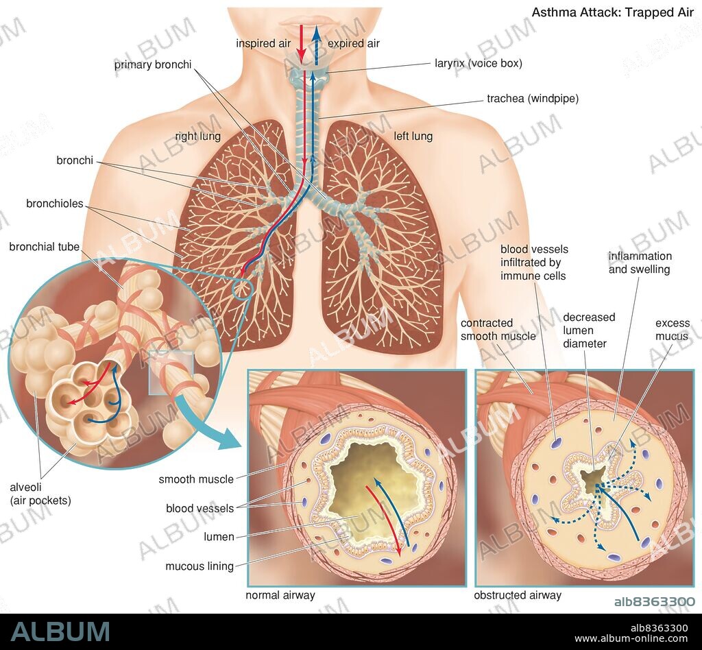The anatomy of an asthma attack, demonstrating the difference between a normal and an obstructed airway.