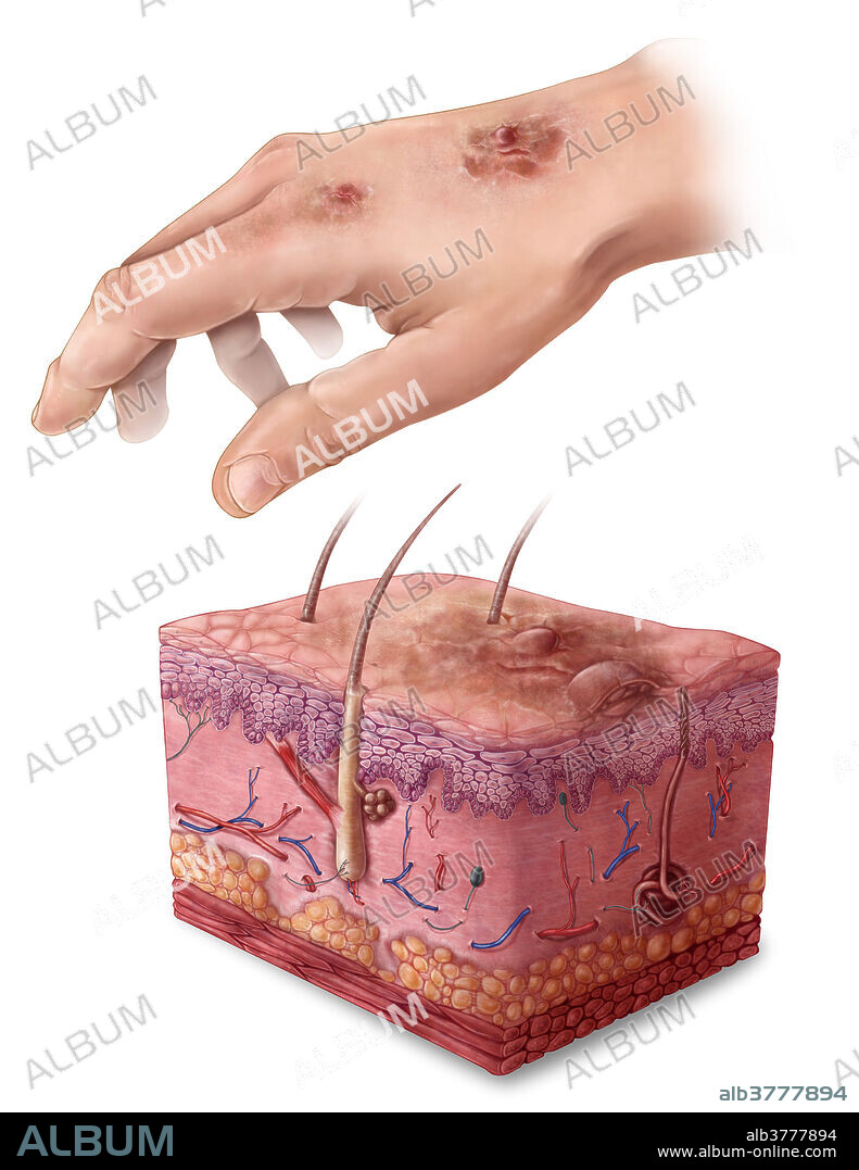 An illustration of squamous cell carcinoma, a skin cancer arising from the uncontrolled division of squamous epithelial cells in the epidermis. Symptoms include the appearance of reddish lesions or raised ulcers that may form a hard, plaque-like surface, and usually develop slowly. Areas which are commonly affected are those which have high or frequent sun exposure, such as the back of the hand, scalp, lip or nose. Treatment usually requires surgery to remove the cancerous areas before they metastasize.
