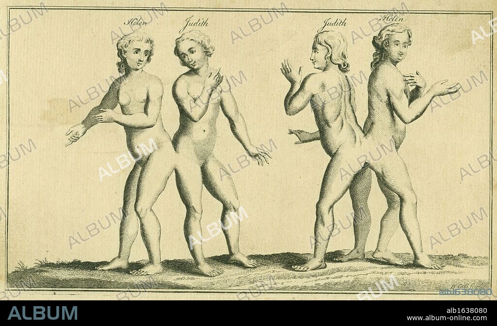 Siamese or conjoined twins. Helen and Judith, the Hungarian Sisters, born in Szony in 1701. Joined at the base of the spine, they were exhibited in England, France, Germany, Holland and Poland. At the age of 9 they were placed in a convent, where they died at the age of 21 or 22. Engraving from "The Universal Magazine" (London, 1756).