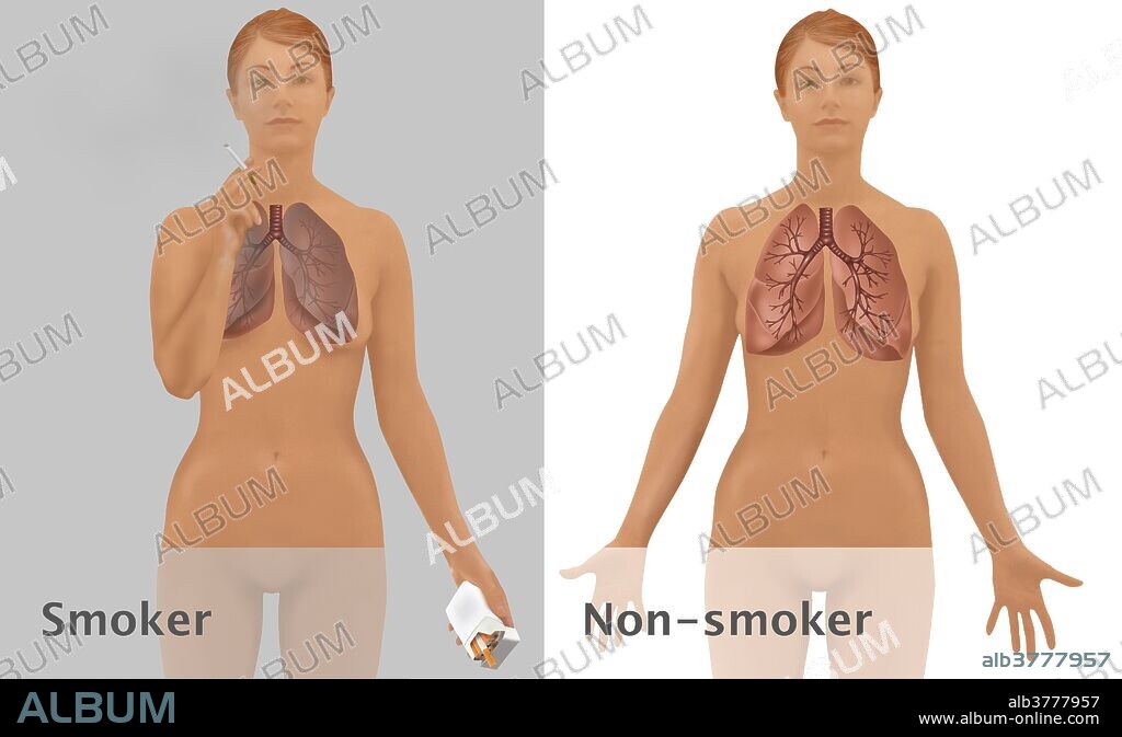 Illustration comparing the lungs of a smoker (left) to the lungs of a non-smoker. Smoking can result in chronic obstructive pulmonary disease (COPD), emphysema, and cancer.