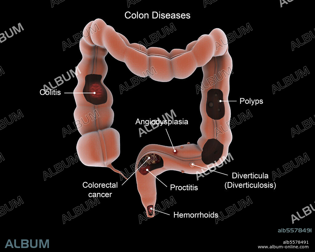 Medical illustration showing types of colon diseases.