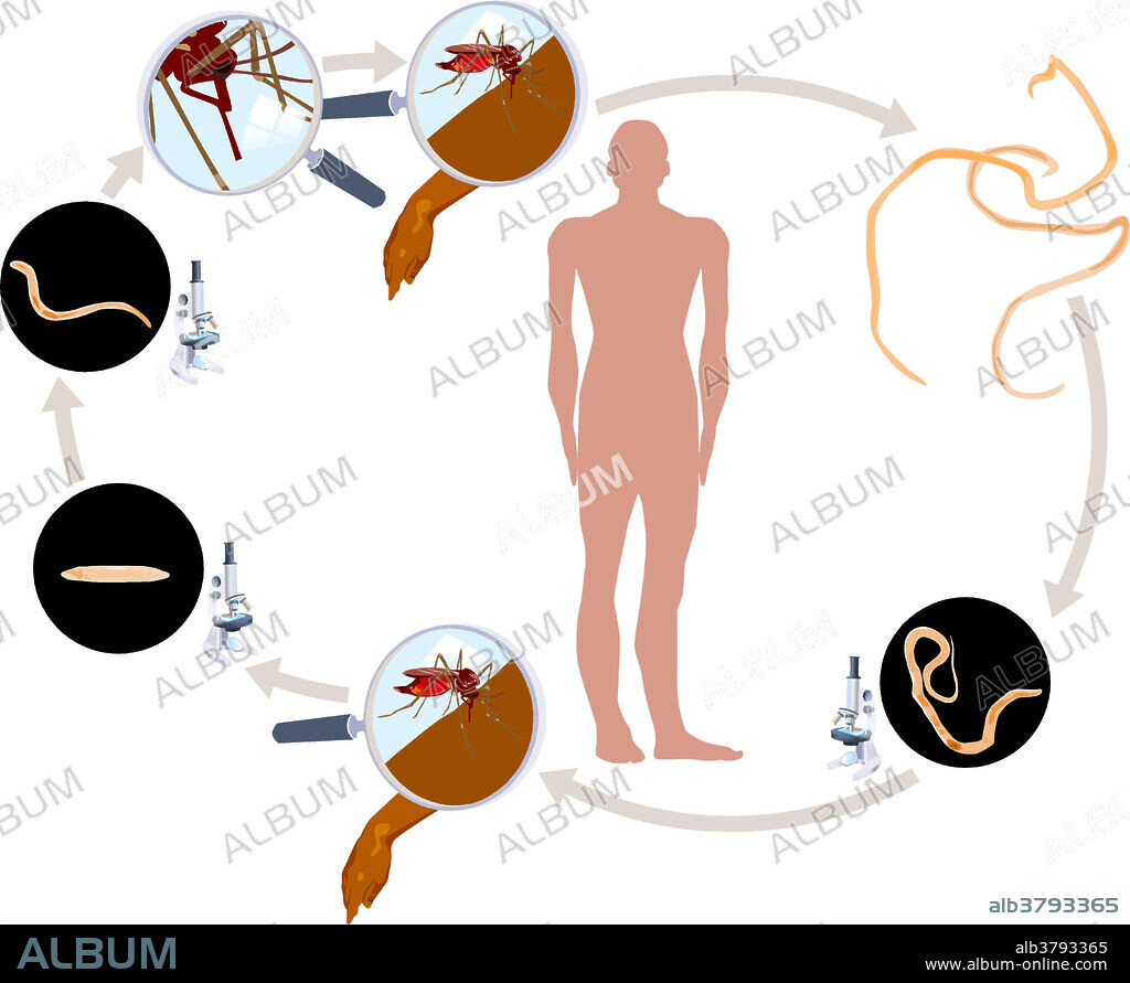 Lifecycle of Lymphatic Filariasis, also known as elephantiasis, a disease transmitted by mosquito bites. Elephantiasis results when parasitic filarial worms Wuchereria bancrofti and Brugia malayi lodge in the human lymphatic system.