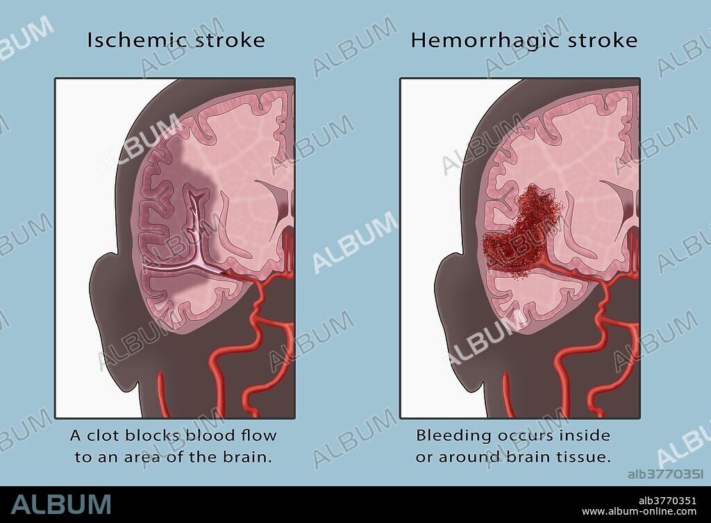 Ischemic stroke and Hemorrhagic stroke. In a Ischemic stroke a clot blocks blood flow to an area of the brain. In a Hemorrhagic stroke bleeding occurs inside or around brain tissue.