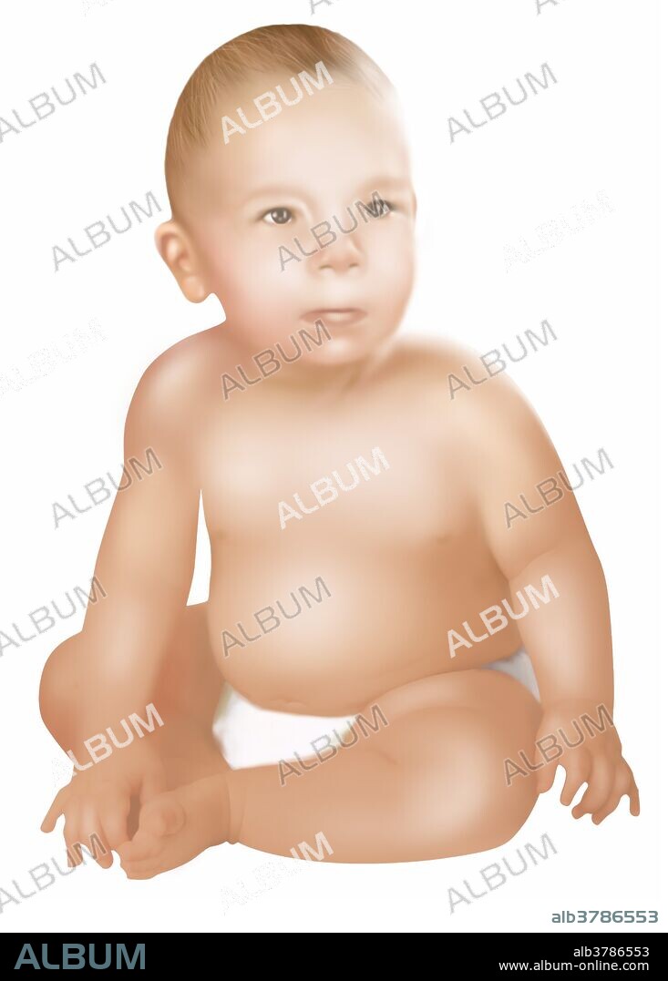 Illustration of baby with Fetal Alcohol Syndrome. Fetal Alcohol Syndrome or (FAS) is a condition in infants that is caused by alcohol consumption by the mother during time of pregnancy. Mental and physical defects such as a small head, flat face, epicanthal folds, smooth philtrum, thin upper lip, small eye openings, short nose, low nasal bridge, and underdeveloped jaw, are common symptoms of fetal exposure to alcohol.