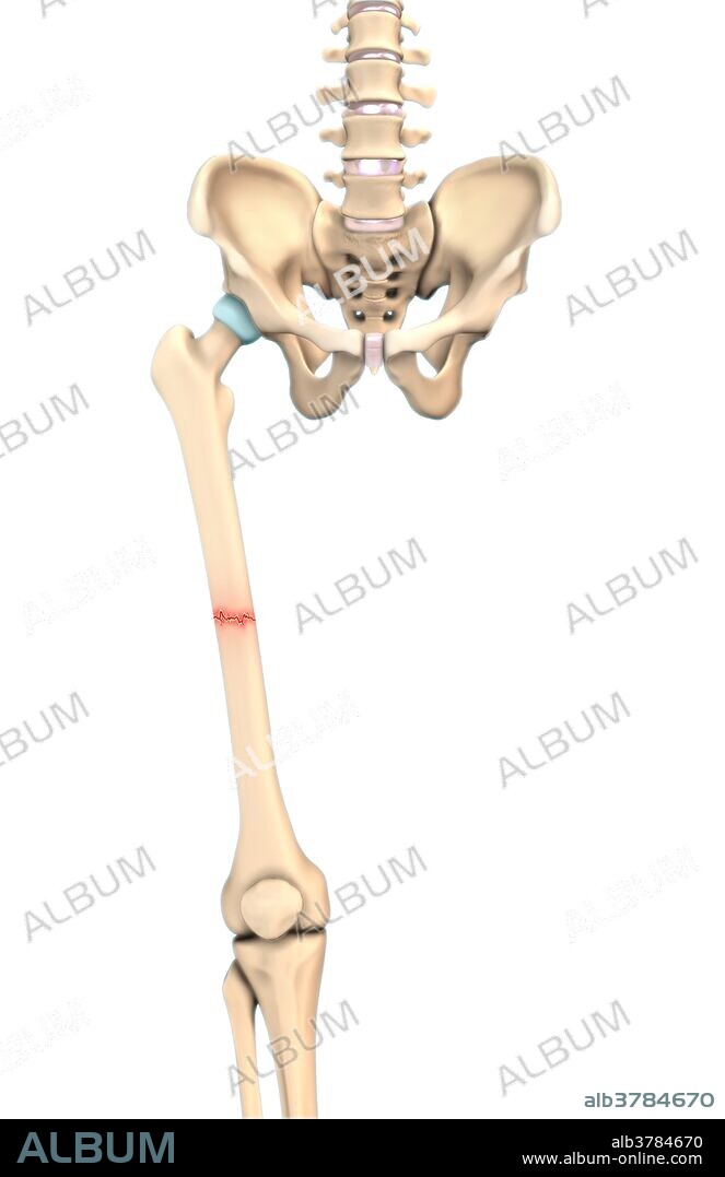An illustration of a transverse fracture in which a break is at a right angle to the bone's long axis.