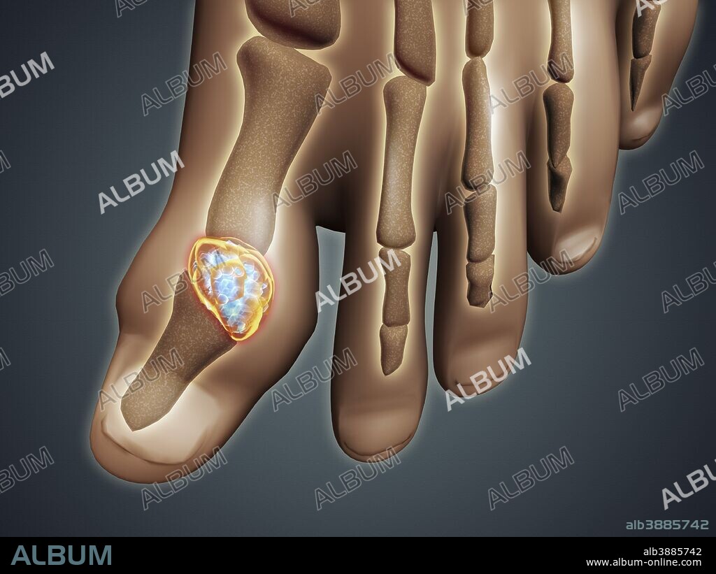 Conceptual image of gout in the big toe. Gout is a form of inflammatory arthritis that causes sudden, severe pain, swelling and tenderness of joints.