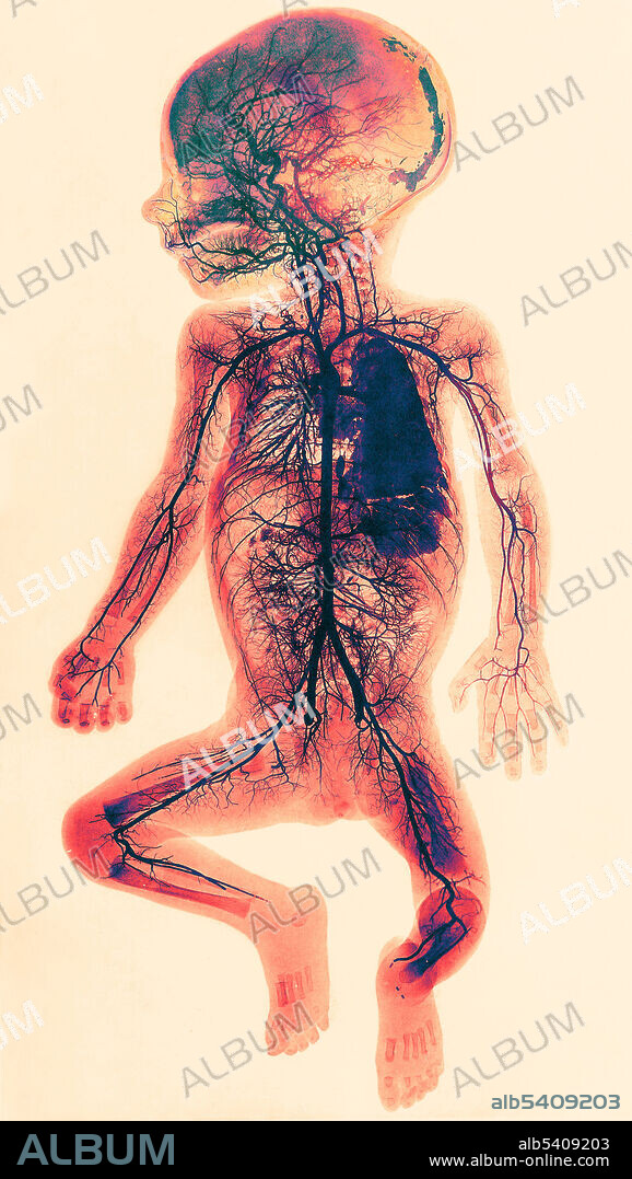 An injected arterial vessel system of a 9-month-old fetus. Collotype after an x-ray by E. Rommler for Gerhard Leopold and Th. Leisewitz. Text accompanying the image reads: "The ramification of the vessels in neck and head is very distinct: the vertebrales, carotis communis, the division into interna and externa, the maxillaris externa with the rami labiales, its anastomose with the dorsalis nasi, the art. Iingualis with its ramus dorsalis linguae and finally the region of the terminal ramification of the carotis interna. An abnormality of the right brachialis is to be noted: the radialis originates in the initial part of it and proceeds along and behind it. The vessels of the lower extremities are less clearly visible. The ramifications of the mesenterica sup., and of the two renales are very distinct. A branch of the hepatica seems to be ruptured, as a part of the liver is filled out with injection substance. In the remaining part, however, the finest capillaries are discernible. The right lung is filled with injection substance, the vessels of the left one are very distinct, and also the intercostales stand out clearly.".