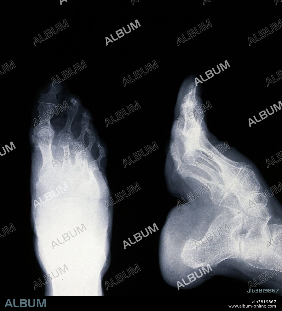 X-ray of bound foot: top and side view. Foot binding is the custom of applying painfully tight binding to the feet of young girls to prevent further growth. The practice possibly originated among upper-class court dancers during the Five Dynasties and Ten Kingdoms period in Imperial China (10th or 11th century), but spread in the Song Dynasty and eventually became common as a mark of status and beauty. The Manchu Emperor Kangxi tried to ban footbinding in 1664 but failed. In the 1800s, Chinese reformers challenged the practice but it was not until the early 20th century that foot binding began to die out, partly from changing social conditions and partly as a result of anti-foot binding campaigns. Foot-binding resulted in lifelong disabilities for most of its subjects.