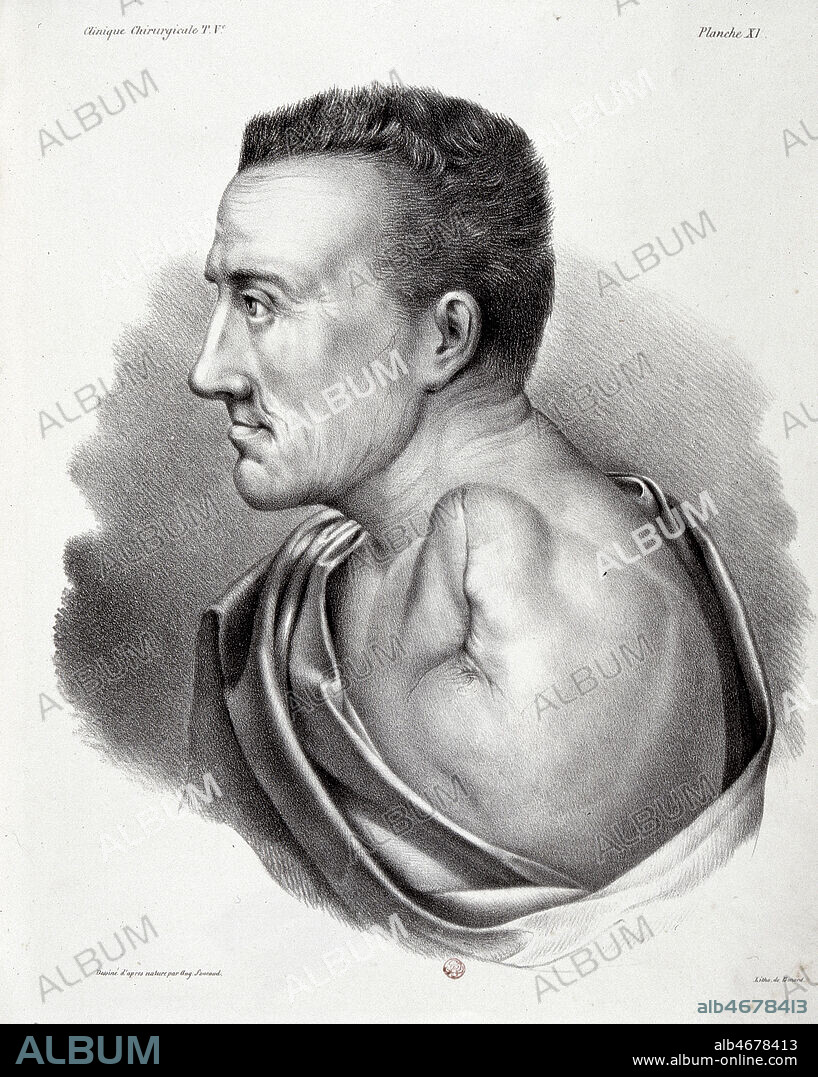 'Cicatrice de l'amputation d'un bras a l'epaule' dessin de 1829 par Aug. FOUCAUD ( 19eme s.) pour 'Clinique chirurgicale, exercee particulierement dans les camps et les hopitaux militaires, depuis 1792 jusqu'en 1829' par le Baron Dominique-Jean LARREY (1766-1842), a Paris en (19e s., 19eme s., XIXe s.) Coll. Jean Vigne/KHARBINE TAPABOR.