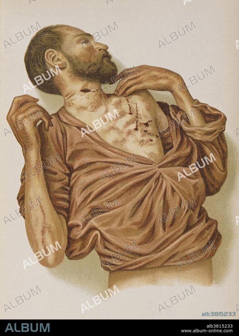 Suicide through Stabbing, 1898. Physician who had taken his life in a hotel. The body was covered with freshly coagulated blood, and clothed only with a shirt, which was saturated with blood. Extensive blood-marks reached from the body to the bed, the covering of which was likewise saturated with blood, and beside which a large, open pocket-knife lay. After cleansing the body six stab-wounds were recognized. Of these one was situated in the right side of the neck, the other five on the anterior surface of the chest. That it was a case of suicide was demonstrated by the external circumstances and all the postmortem findings. It was clear that the deceased had produced the wounds while in bed, and that he had then attempted to arise and go to the door, where he fell. The opened and uninjured shirt, the symmetric disposition of the openings of the stab-wounds and of the course of the canal of the wounds, and the proximity of the wounds of the chest were more indicative of suicide than of murder. The motive for committing the deed may have been the tuberculous disease. Annotated from Eduard Ritter von Hofmann, M.D., Atlas of Legal Medicine.