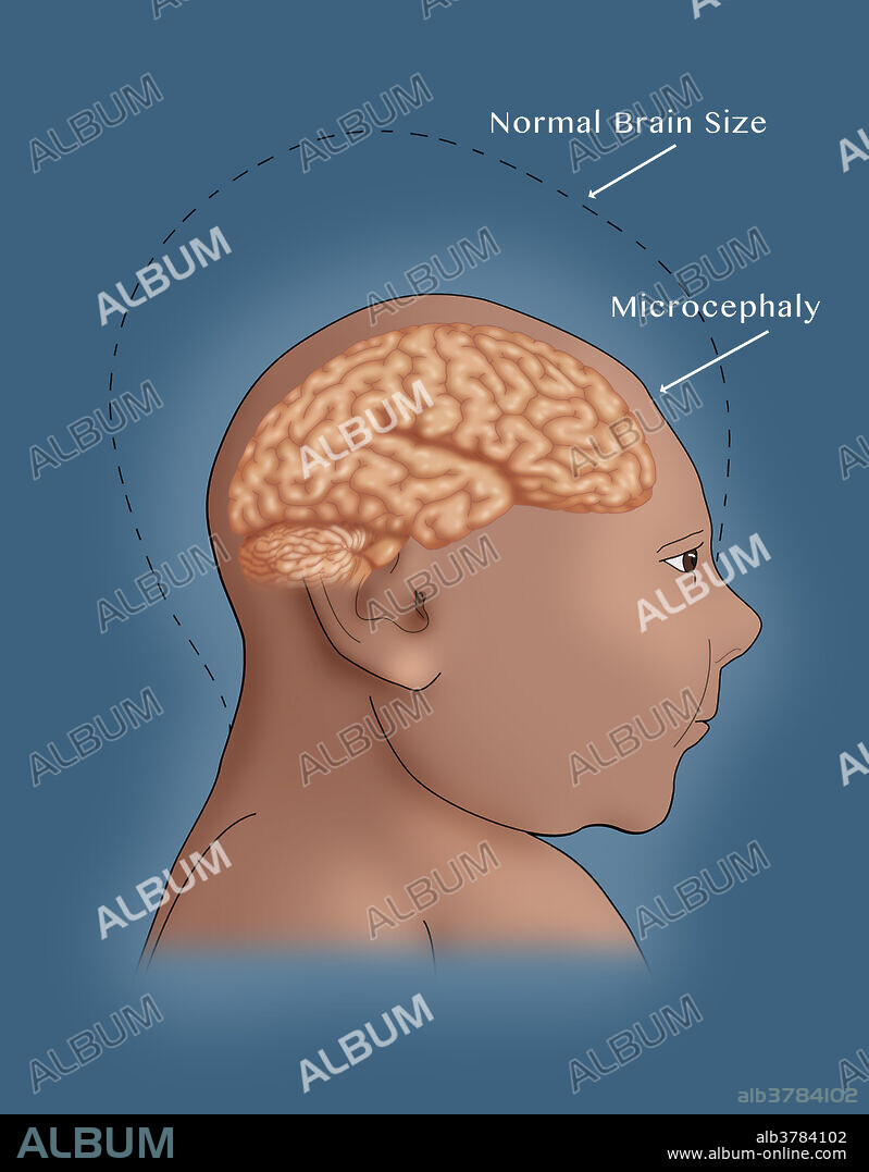 A conceptual illustration showing a comparison of a normal brain and one with microcephaly, a neurodevelopmental disorder associated with abnormal growth of the brain due to reduced head size. Microcephaly may be congenital or it may develop a few years after birth. Newborns affected by microcephaly may exhibit neurological defects, seizures, and impaired intellectual development. There's circumstantial evidence pointing to the Zika virus as a cause of a large number of cases of microcephaly in Brazil that is currently being investigated.