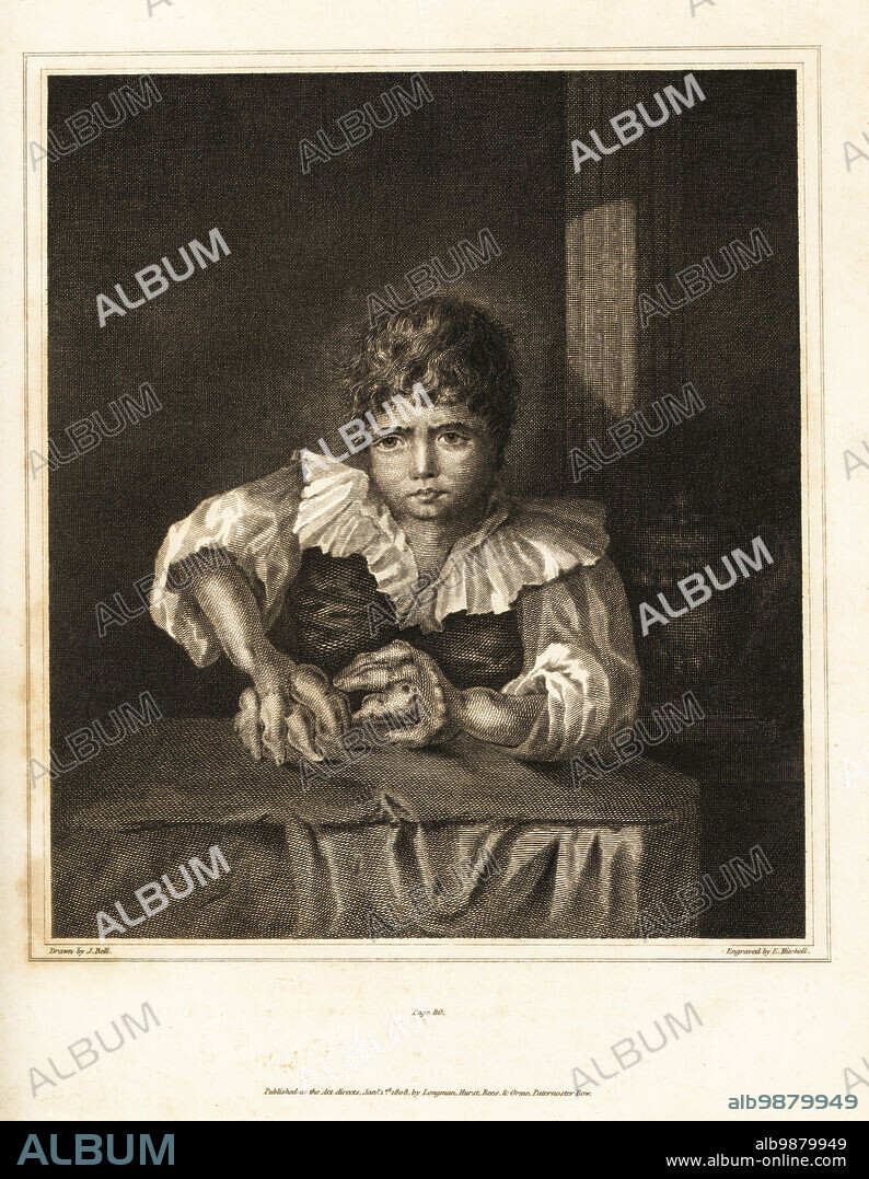 Young boy from Westmoreland with bone tumors in the hands and wrists, 1795. Bell and Alex Munro recommended amputation or a treatment of mercury, laudanum and Confectio-Japonica (compound electuary of catechu). Copperplate engraving by Edward Mitchell after an illustration by John Bell from his own Principles of Surgery, as they Relate to Wounds, Ulcers and Fistulas, Longman, Hurst, Rees, Orme and Brown, London, 1815.