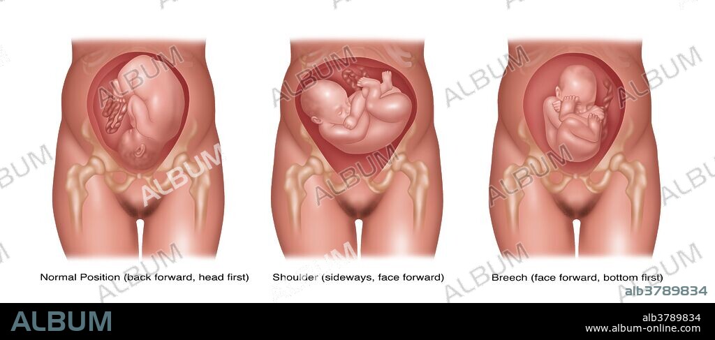 Fetus positions. At left, normal positioned fetus with their back forward and head positioned down. In middle, shoulder presentation where the fetus is sideways and their face is turned forward. At right, breech position where the fetus is faced forward and their buttocks are positioned at the bottom and head at the top. If the baby is in the shoulder or breech position a cesarean section is performed to deliver the baby.