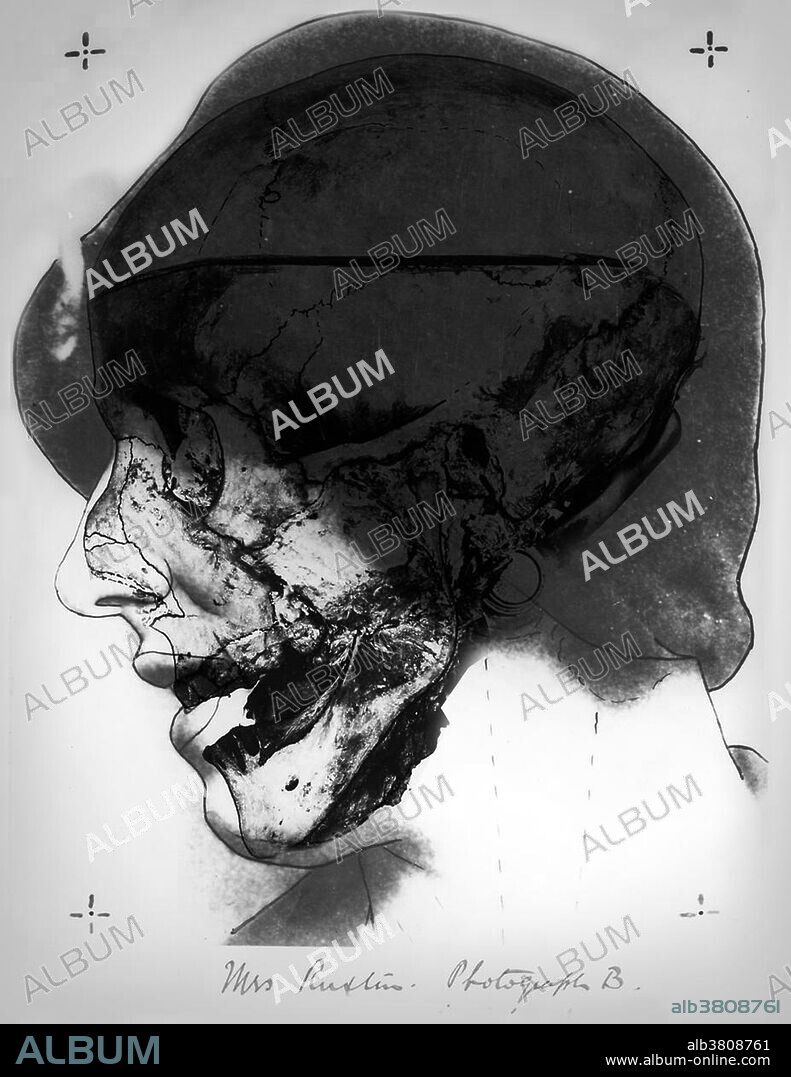Skull no. 2, photograph B, 1935. Investigators photographed the Skull No. 2 in the same orientation as an existing photograph of Isabella Ruxton. Then they laid a photo-transparency of this skull over the portrait to establish that the skull was hers. Buck Ruxton (1899-1936) was a Parsi doctor and murderer who strangled his wife Isabella. In order to prevent their housemaid, Mary Jane Rogerson, from discovering his crime before he could dispose of the body, he suffocated her too. Ruxton then proceeded to dismember and mutilate both bodies to hide their identities. The case is remembered now for the innovative forensic techniques employed in solving it. The bodies were identified using the fledgeling techniques of fingerprint identification, forensic anthropology to superimpose a photograph over the X-ray of a victim's skull and forensic entomology to identify the age of maggots and thus the approximate date of death. This was one of the first cases where such forensic evidence was successfully used to convict a criminal in the United Kingdom.