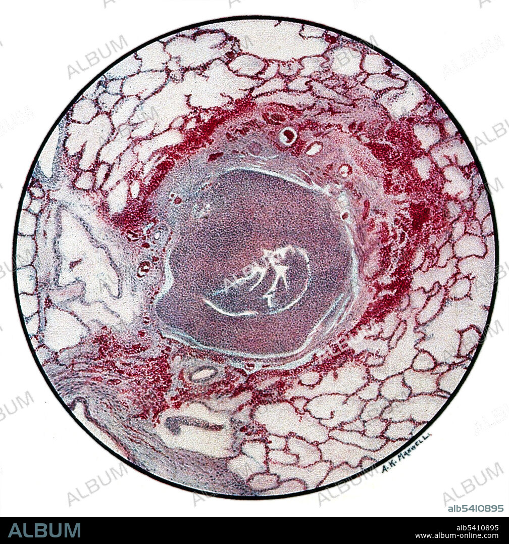 Drawing of a microscopic section of lung tissue damaged by mustard gas poisoning during World War I. The patient died at the end of the second day, 40 hours after the attack. Drawing by A. Kirkpatrick Maxwell, 1917. The bronchiole is filled with fibrin and pus cells, and its lining epithelium has been completely destroyed. The inflammation has caused a characteristic ring of hemorrhage in the tissues around the bronchial tube, and infection is beginning to appear in the alveoli nearest to the these inflamed tissues. Sulfur mustard, commonly known as mustard gas, was first used effectively in World War I by the German army against British and Canadian soldiers near Ypres, Belgium, in 1917 and later also against the French Second Army.