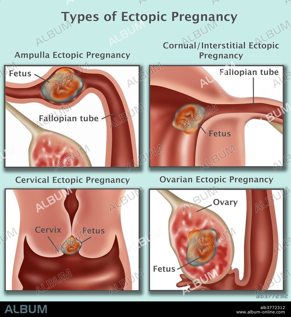 Ectopic Pregnancy