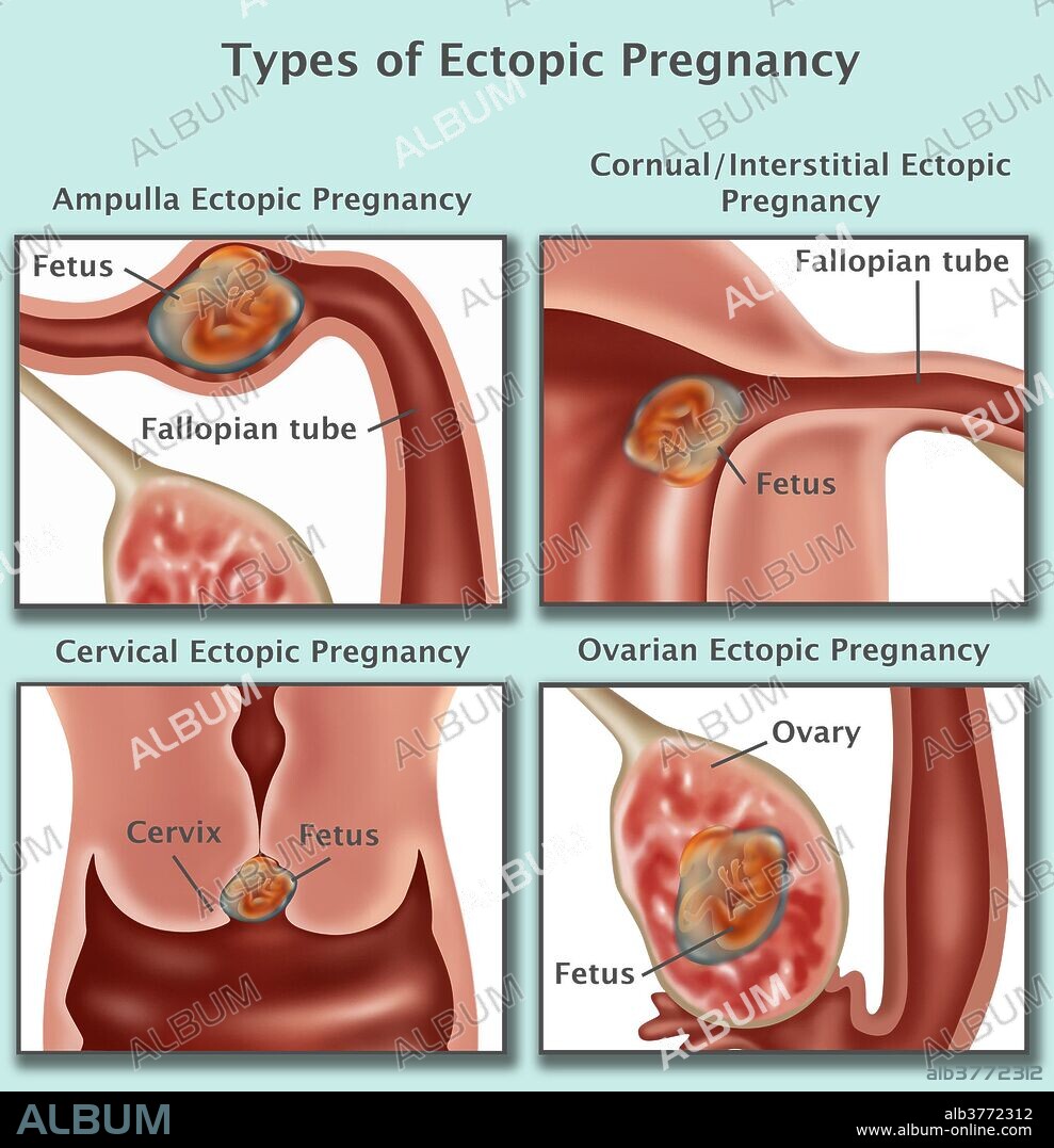 Illustration of four ectopic pregnancies. Pregnancies occurring in the Ampulla (top left), Interstitial Fallopian Tube (top right), cervix (bottom left), and the ovary (bottom right). As the ectopic pregnancy develops, the growing embryo may rupture the surrounding tissues causing serious bleeding. Surgery is usually performed to remove the embryo, and to repair or remove the area of implantation.