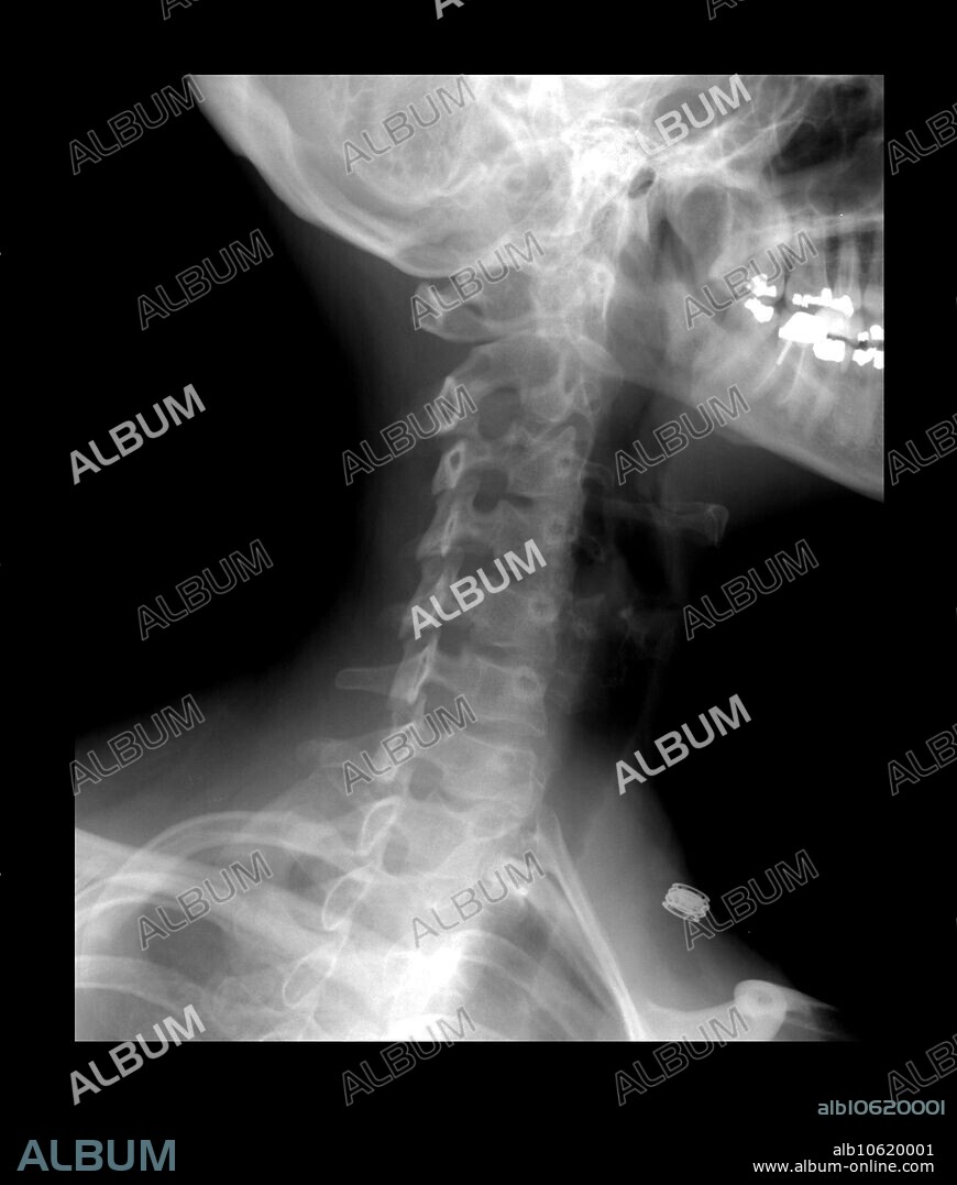 This oblique view of a normal cervical spine clearly shows the neural foramina which are the bony tunnels through which the nerve roots arising from the cervical spinal cord exit the spinal canal to enter the neck. Bony spurs narrowing the neural foramina are usually well demonstrated on this view.