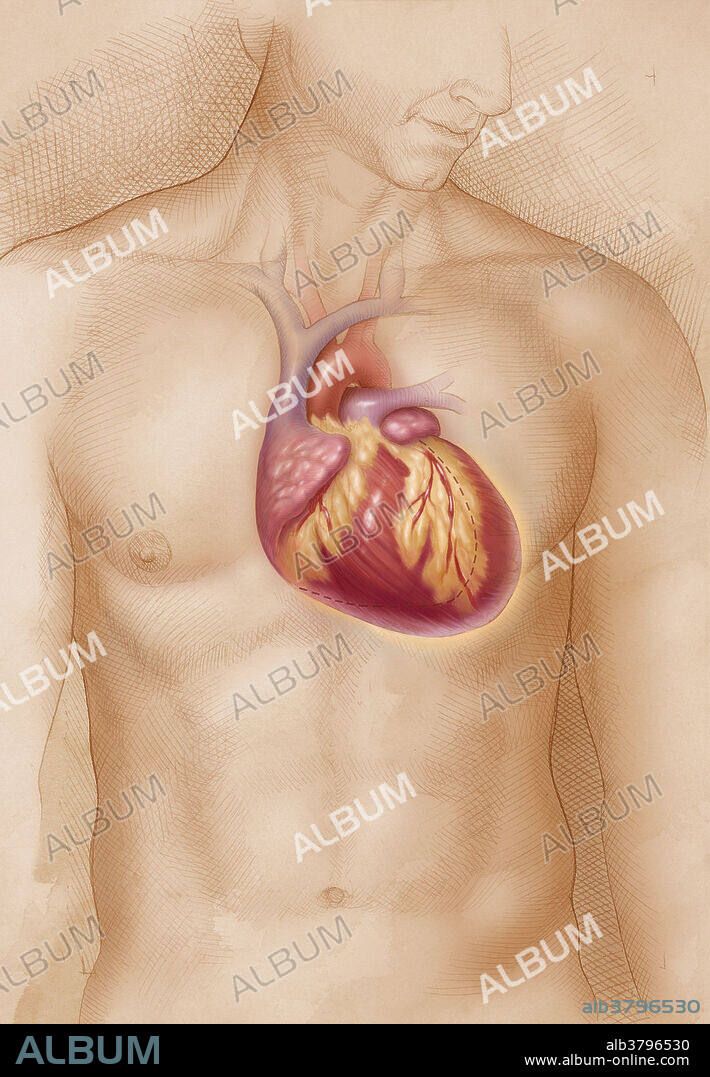 Illustration showing an enlarged heart, known as the medical condition, Cardiomegaly.