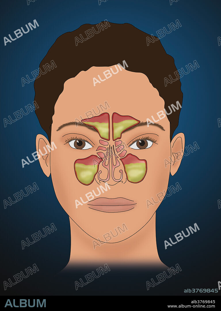 Sinusitis, illustration. Sinusitis, also known as a sinus infection or rhinosinusitis, is inflammation of the sinuses resulting in symptoms. Common signs and symptoms include thick nasal mucus, a plugged nose, and pain in the face. Other signs and symptoms may include fever, headaches, poor sense of smell, sore throat, and cough. The cough is often worse at night. Serious complications are rare. It is defined as acute rhinosinusitis (ARS) if it lasts less than 4 weeks, and as chronic rhinosinusitis (CRS) if it lasts for more than 12 weeks.
