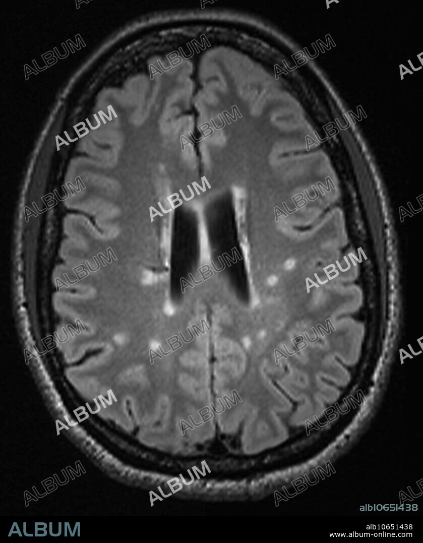 3.0T SPACE transverse axial 2mm MRI of 30 year old female with multiple sclerosis. Images reveal multiple foci of demyelinating disease throughout the periventricular and deep white matter. Lesions oriented perpendicular to ventricular system are typical of Dawson's fingers seen with MS.
