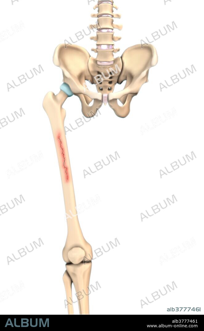 An illustration of a linear fracture in which a break occurs along the bone's long axis.