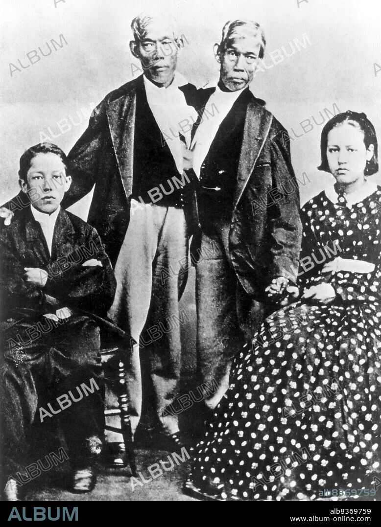 Chang and Eng Bunker (May 11, 1811 January 17, 1874) were Thai-American conjoined twin brothers whose condition and birthplace became the basis for the term 'Siamese twins'.<br/><br/>. The Bunker brothers were born on May 11, 1811, in the province of Samutsongkram, near Bangkok, in the Kingdom of Siam (today's Thailand). Their fisherman father was a Chinese Thai, while their mother was a Chinese Malaysian. Because of their Chinese heritage, they were known locally as the 'Chinese Twins'. The brothers were joined at the sternum by a small piece of cartilage, and though their livers were fused, they were independently complete.<br/><br/>. In 1829, Robert Hunter, a Scottish merchant who lived in Bangkok, saw the twins swimming and realized their potential. He paid their parents to permit him to exhibit their sons as a curiosity on a world tour. When their contract with Hunter was over, Chang and Eng went into business for themselves. In 1839, while visiting Wilkesboro, North Carolina, the brothers were attracted to the area and purchased a 110-acre (0.45 km2) farm in nearby Traphill.<br/><br/>. Determined to live as normal a life they could, Chang and Eng settled on their small plantation and bought slaves to do the work they could not do themselves. Using their adopted name 'Bunker', they married local women on April 13, 1843. Chang wed Adelaide Yates, while Eng married her sister, Sarah Anne. Chang and Adelaide would become the parents of eleven children. Eng and Sarah had ten. The twins also became naturalized American citizens.<br/><br/>. On January 17, 1874, Chang died while the brothers were asleep. Eng awoke to find his brother dead and cried, 'Then I am going'. A doctor was summoned to perform an emergency separation, but he was too late. Eng died approximately three hours later.
