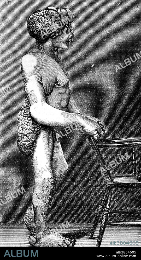 Joseph Carey Merrick (1862-1890) was an English man with severe deformities who was exhibited as a human curiosity named the Elephant Man. He became well known in London society after he went to live at the London Hospital. Although his condition was incurable, Merrick was allowed to stay at the hospital for the remainder of his life. English surgeon Frederick Treves visited him daily and the pair developed quite a close friendship. Merrick was originally thought to be suffering from elephantiasis. He died in 1890, aged 27. The official cause of death was asphyxia, although Treves, who dissected the body, said that Merrick had died of a dislocated neck. The exact cause of Merrick's deformities is unclear. The dominant theory was that Merrick suffered from neurofibromatosis type I. In 1986, a new theory emerged that he had Proteus syndrome. In 2001 it was proposed that Merrick had suffered from a combination of neurofibromatosis type I and Proteus syndrome. DNA tests conducted on his hair and bones have proven inconclusive.