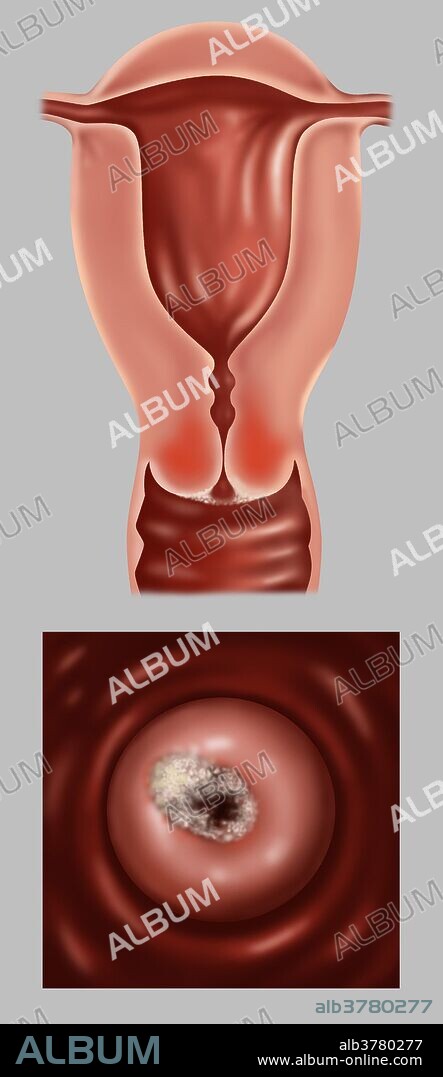 Medical illustration showing early stage IB of cervical cancer. This stage is defined by clinically visible lesions, less than 4 centimeters across the greatest dimension, limited to the cervix uteri. Symptoms of cervical cancer include bleeding between periods, pain after sexual intercourse and heavier periods. Cancer of the cervix is rare and if detected early is almost always cured.