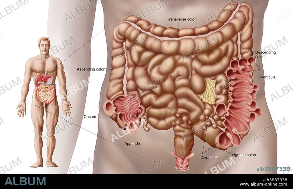 Illustration of diverticulitis in the descending colon region of the human intestine. Diverticulitis is a common digestive desease of the intestines.