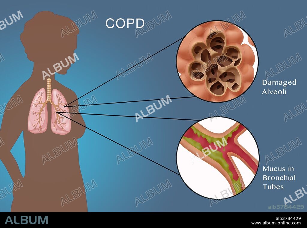 Illustration of chronic obstructive pulmonary disease (COPD), a common lung disease where breathing is difficult. There are two main forms of COPD: Chronic bronchitis, whose symptoms include a long-term cough with mucus) (inset bottom) and emphysema (the gradual breakdown of the lungs) (inset top). Most people with COPD have a combination of both forms. COPD is caused by noxious particles or gas, most commonly from tobacco smoking, which triggers an abnormal inflammatory response in the lung.