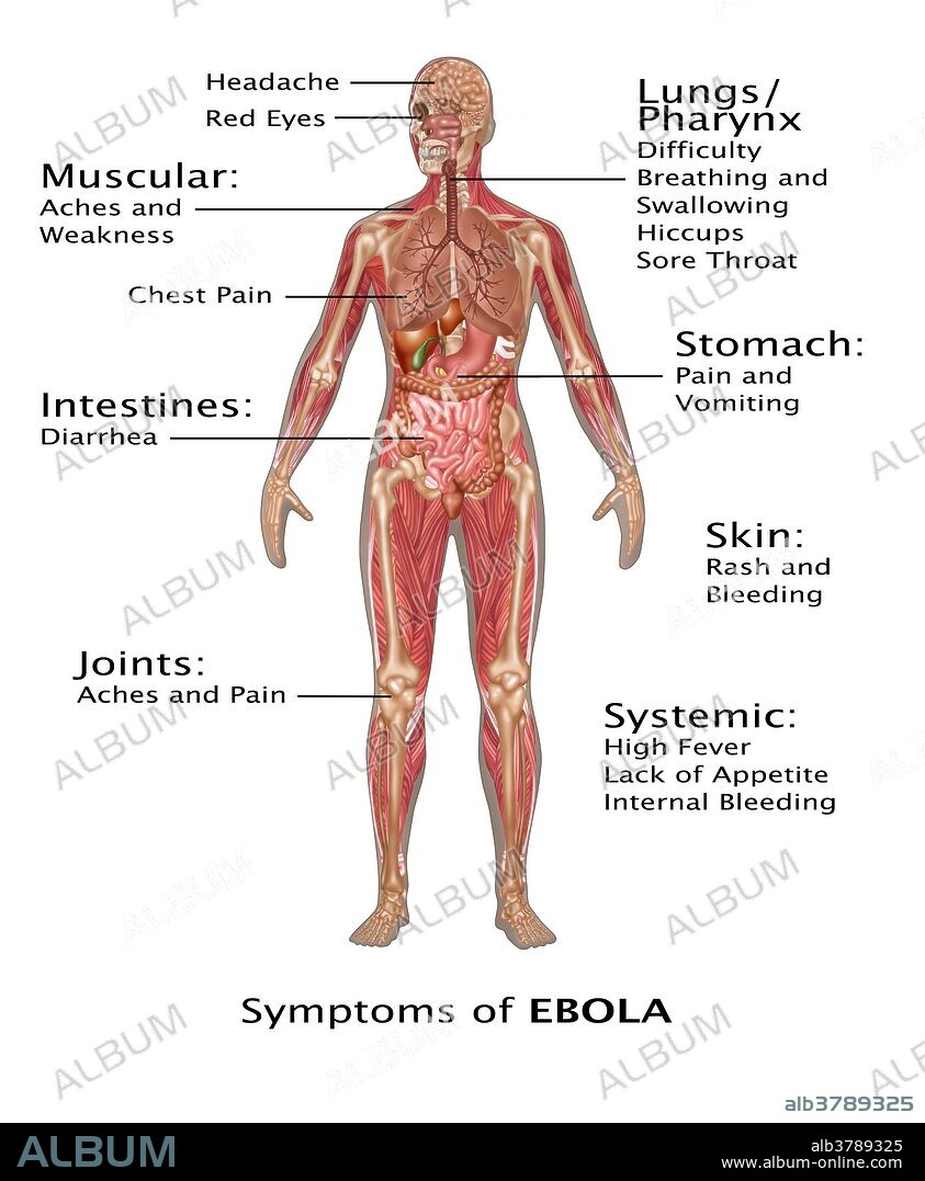 Ebola virus in the human body. The ebola virus infects humans through direct contact with body fluids or the blood of a sick person, animal or contact with contaminated objects. Signs and symptoms which typically start between two days and three weeks after contracting the ebola virus disease (EVD) include complications in the Lungs/pharynx, stomach, skin, joints, and intestines. The virus eventually leads to hemorrhage and organ failure. Ebola results in death among 90% of its victims.