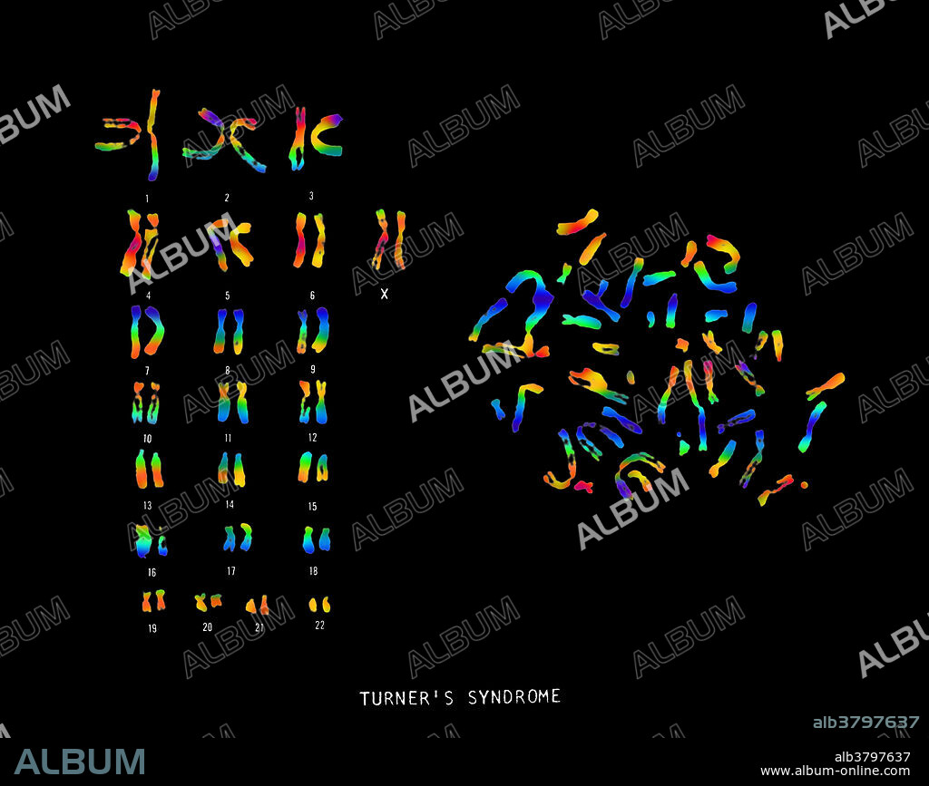Colour enhanced micrograph of the karyotype of a patient with Turner's syndrome. A karyotype is an arrangement of the set of chromosomes. Turner's syndrome, which only affects women, is an absence of the second sex chromosome. In a healthy woman there would be two X chromosomes instead of one (seen at lower right). The symptoms of Turner's syndrome include stunted growth, retarded sexual development (leading to infertility), and webbing of the skin of the neck. Often heart problems are present too. Turner's syndrome is rare, affecting around one in every 3000 female births.