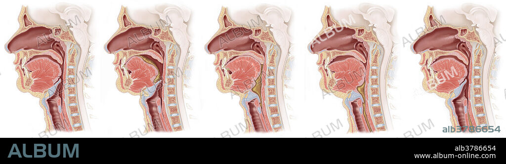 There are four phases involved in swallowing. The oral preparatory phase, the oral propulsive phase and the pharyngeal and esophageal phases. This illustrates the steps involved in the pharyngeal phase (these actions are overlapping and rapid). These steps are described in order from left to right.1. Principal anatomy involved in sagittal section2. Bolus moved to rear of oropharynx, and soft palate begins to elevate. The epiglottis moves to protect airway, while the vocal folds close at the midline. Hyoid bone elevates.3. Epiglottis has closed off larynx, and the soft palate has blocked food entry into the nasopharynx. Tongue elevates.4. Tongue pushes towards back of oropharynx, and inferiorly toward the esophagus. Upper esophageal sphincter relaxes to allow passage of bolus into upper esophagus.5. Upper esophageal sphincter closes after passage of food.