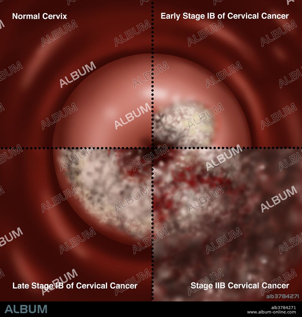 Illustration showing the progression of cervical cancer. Upper left section shows a normal cervix. Upper right section shows the early stage IB of cervical cancer. This stage is defined by clinically visible lesions, less than 4 centimeters across the greatest dimension, limited to the cervix uteri. Lower left shows the late stage IB of cervical cancer, defined by a clinically visible lesion greater than 4 centimeters across its widest dimension. Lower right section shows IIB cervical cancer. This is an advanced stage of the cancer, with extension to the pelvic wall, as seen here. This stage can also result in hydronephrosis (non-functioning kidney). Symptoms of cervical cancer include bleeding between periods, pain after sexual intercourse and heavier periods. Cancer of the cervix is rare and if detected early is almost always cured.