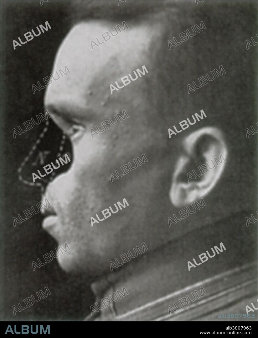 First World War veteran requiring reconstructive nose surgery.  The surgeons frequently used bone fragments and skin flaps from the patient's brow for the operations.  The desired contour has been drawn on the photograph by the surgeon.