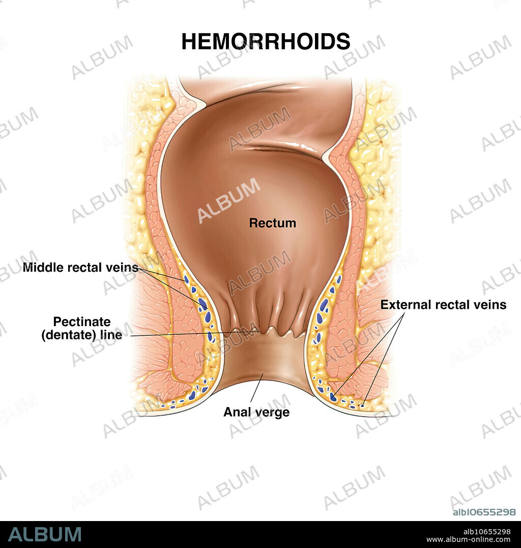 Haemorrhoids, 1 of 3, illustration. Normal ano-rectal anatomy in coronal section.