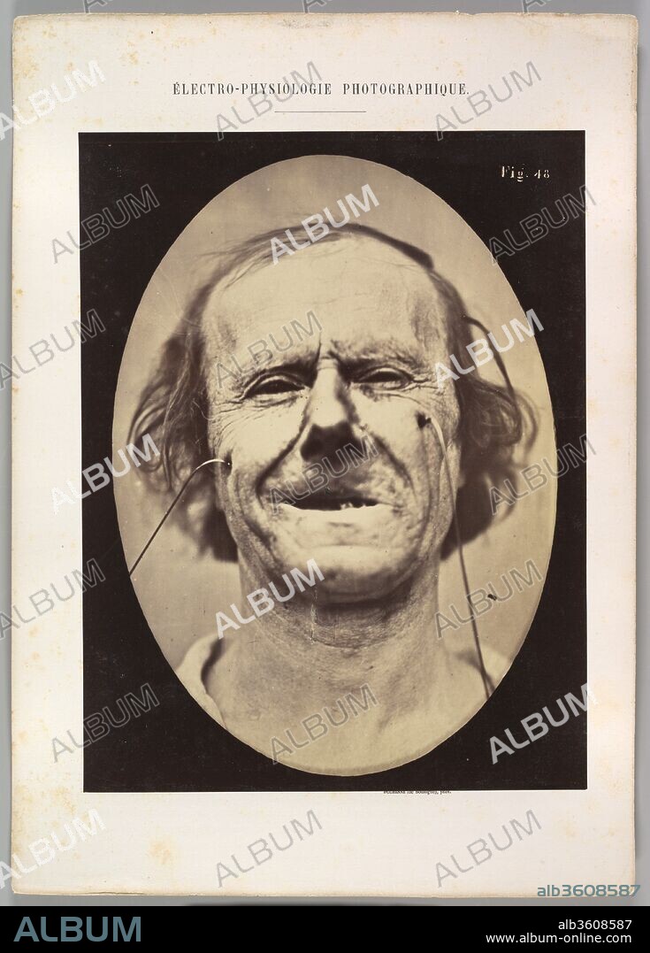 Figure 48: Mild weeping, pity and feeble false laughter. Artist: Guillaume-Benjamin-Amand Duchenne de Boulogne (French, 1806-1875); Adrien Tournachon (French, 1825-1903). Dimensions: Image (Oval): 28.5 × 20.4 cm (11 1/4 × 8 1/16 in.)
Sheet: 30.2 × 23.1 cm (11 7/8 × 9 1/8 in.)
Mount: 40.2 × 28.5 cm (15 13/16 × 11 1/4 in.). Date: 1854-56, printed 1862.